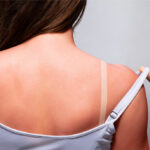 Home-Remedies for Quick Relief From Sunburns